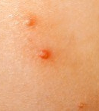 Everything you need to know Molluscum Contagiosum