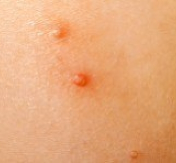 Everything you need to know Molluscum Contagiosum
