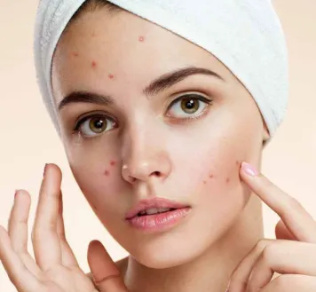 Everything you need to know about Acne
